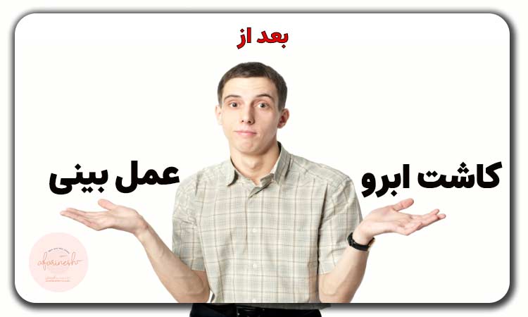 کاشت ابرو بعد از عمل بینی