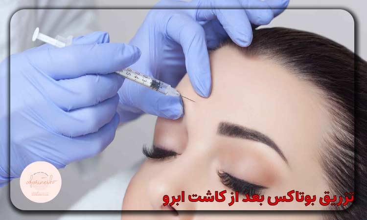 زمان مناسب تزریق بوتاکس بعد از کاشت ابرو
