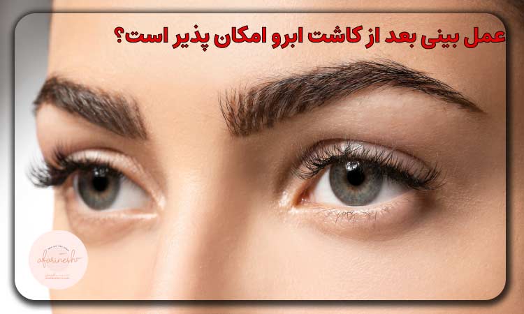 عمل بینی بعد از کاشت ابرو امکان پذیر است؟