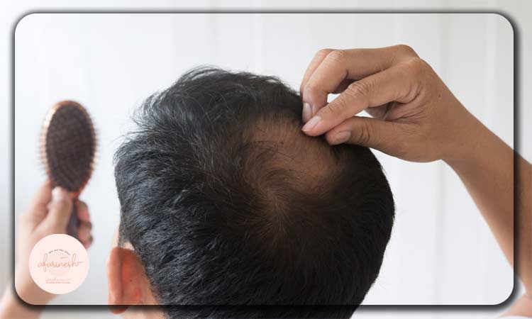 علت ریزش مو چیست؟