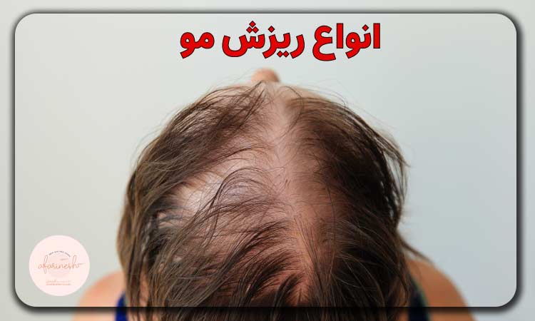انواع ریزش مو