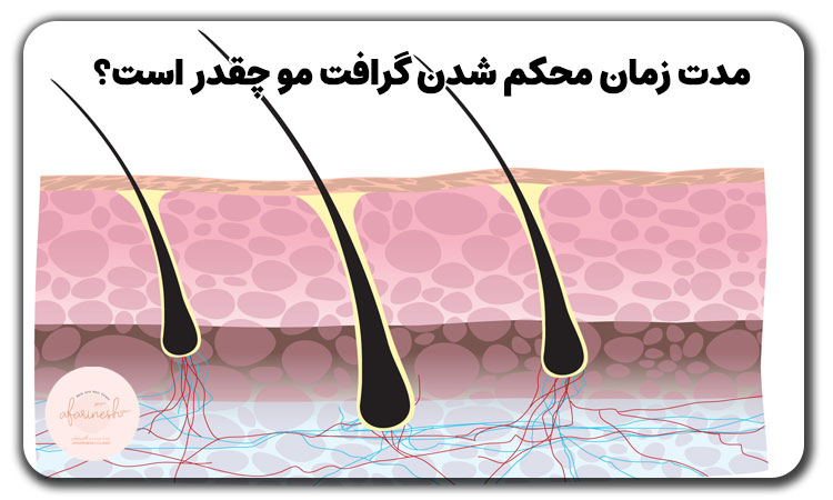 مدت زمان محکم شدن گرافت مو چقدر است؟