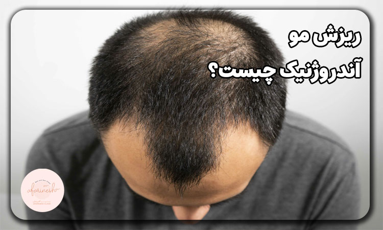ریزش مو آندروژنیک چیست؟