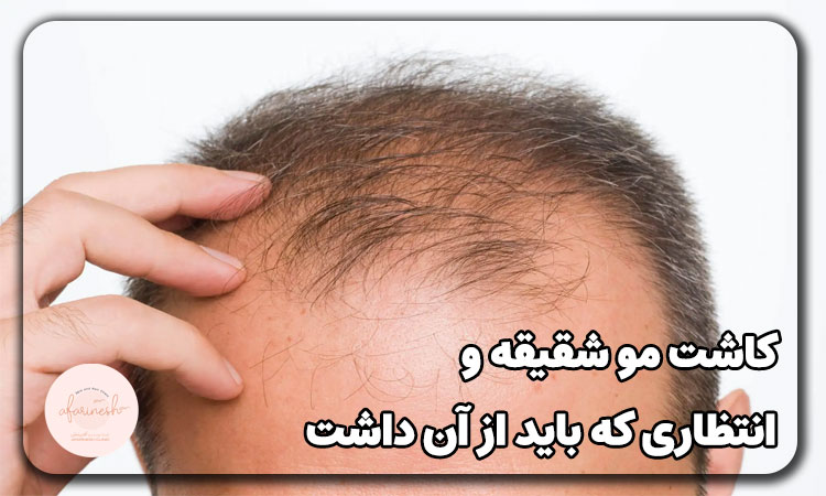 کاشت مو شقیقه و انتظاری که باید از آن داشت