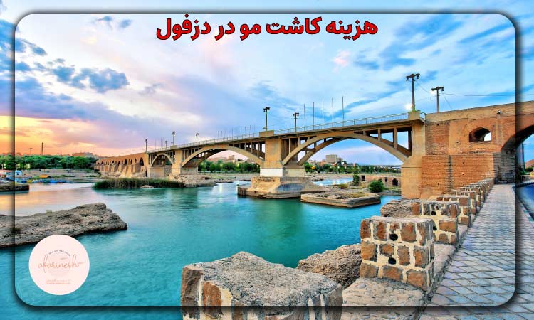 هزینه کاشت مو در دزفول