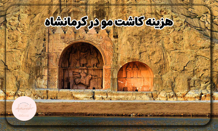 هزینه کاشت مو در کرمانشاه