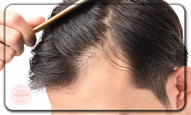 برای کاشت موی شقیقه چقدر گرافت لازم است؟