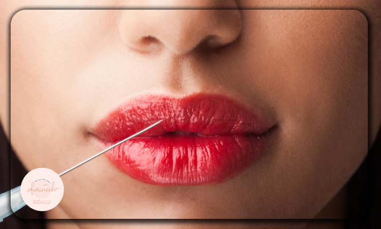 روشهای کاهش درد تزریق ژل به لب