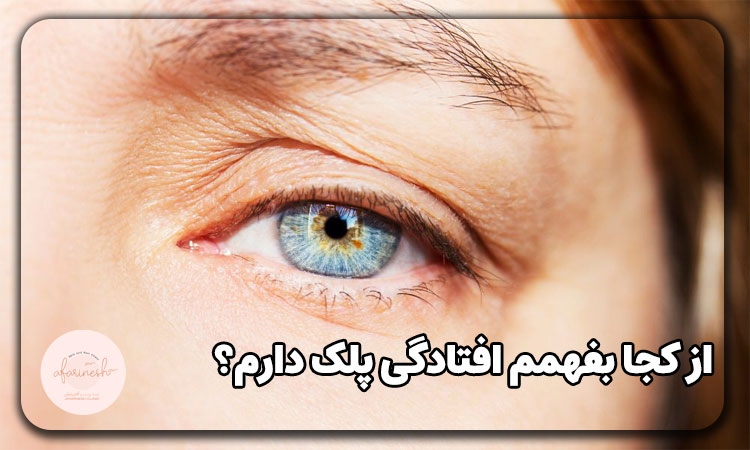از کجا بفهمم افتادگی پلک دارم؟