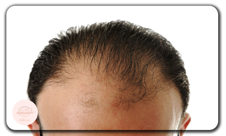 چه کسانی مناسب کاشت مو در شقیقه هستند؟