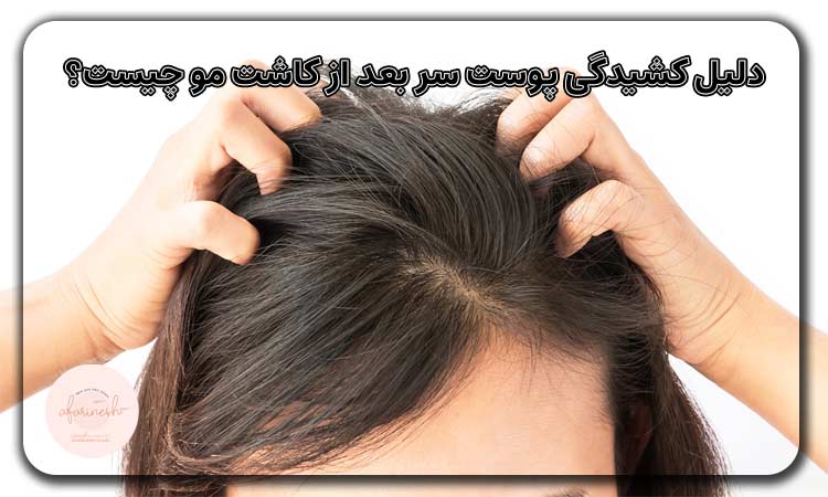 دلیل کشیدگی پوست سر بعد از کاشت مو چیست؟
