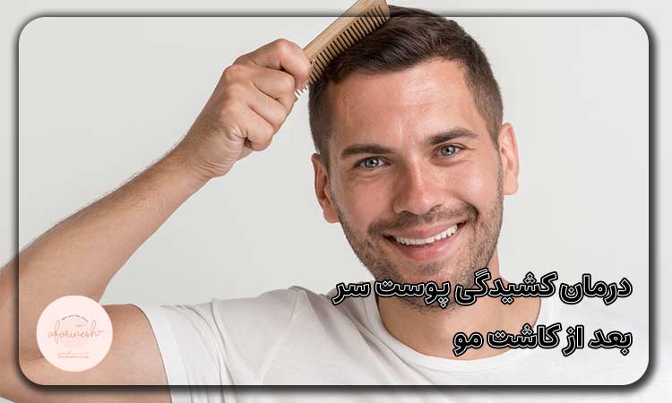 درمان کشیدگی پوست سر بعد از کاشت مو