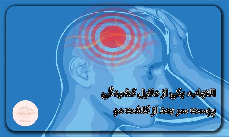 التهاب، یکی از دلایل کشیدگی پوست سر