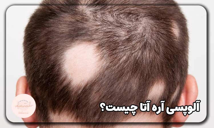 آلوپسی آره آتا