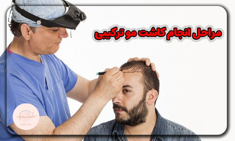 مراحل انجام کاشت مو به روش ترکیبی