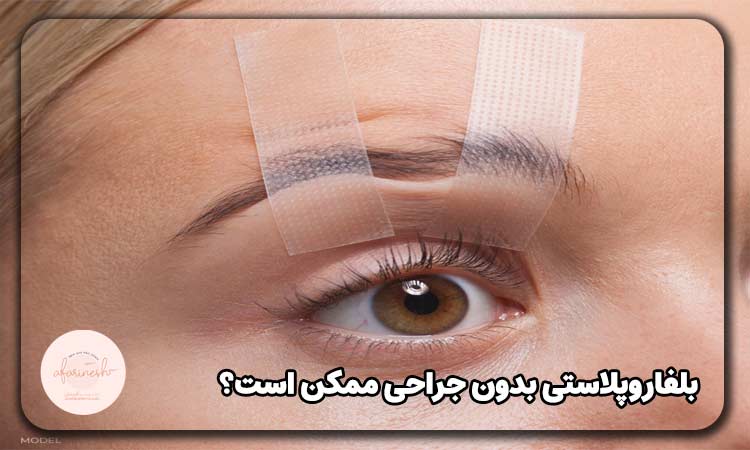 بلفاروپلاستی بدون جراحی