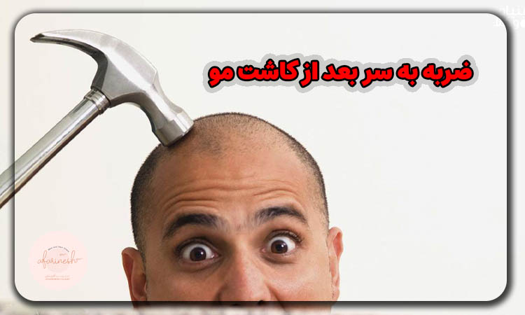 ضربه به سر بعد از کاشت مو