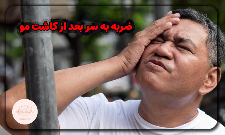 ضربه به سر بعد از کاشت مو