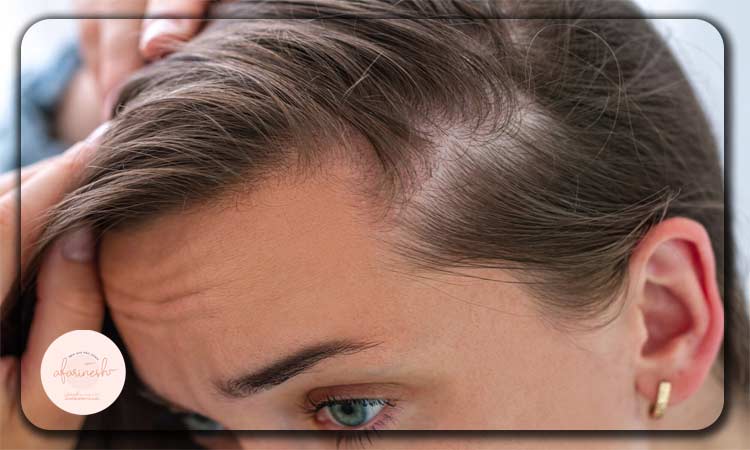 دلایل تلوژن افلوویم