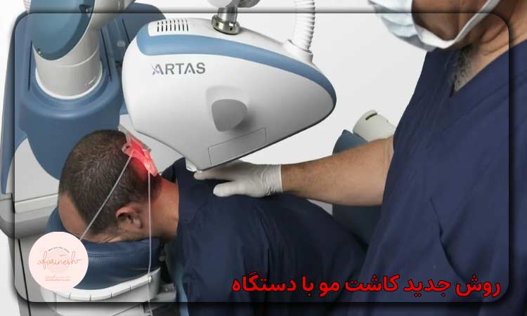 روش جدید کاشت مو با دستگاه