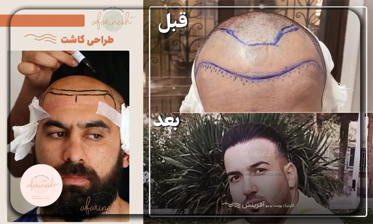 طراحی خط رویش مو