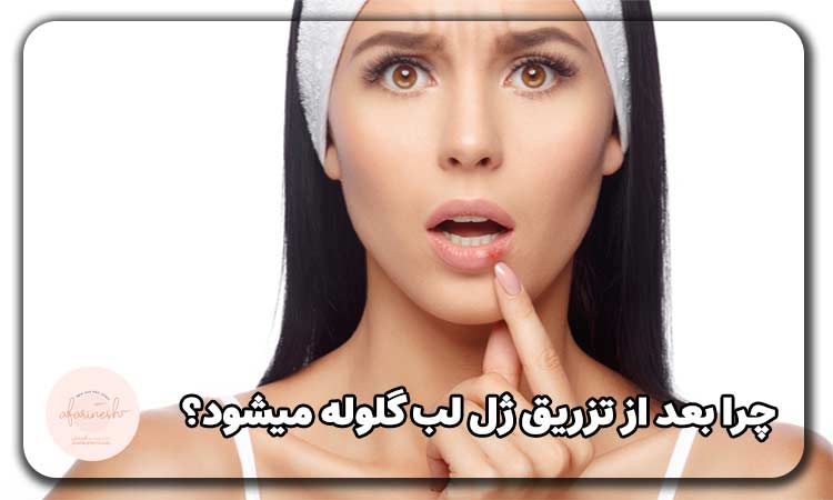 گلوله شدن ژل لب