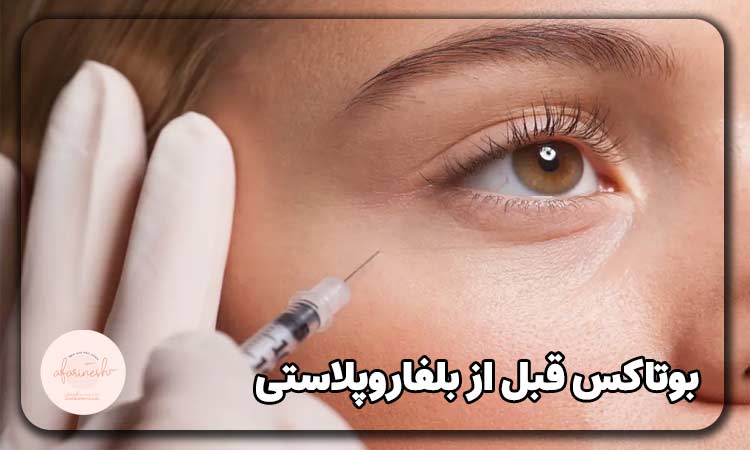 بوتاکس قبل از بلفاروپلاستی