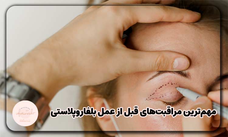 مهم‌ترین مراقبت های قبل از عمل بلفاروپلاستی چیست؟
