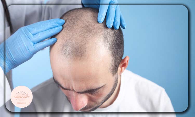کاندیدای مناسب برای پیوند مو به روش فوق ترکیبی