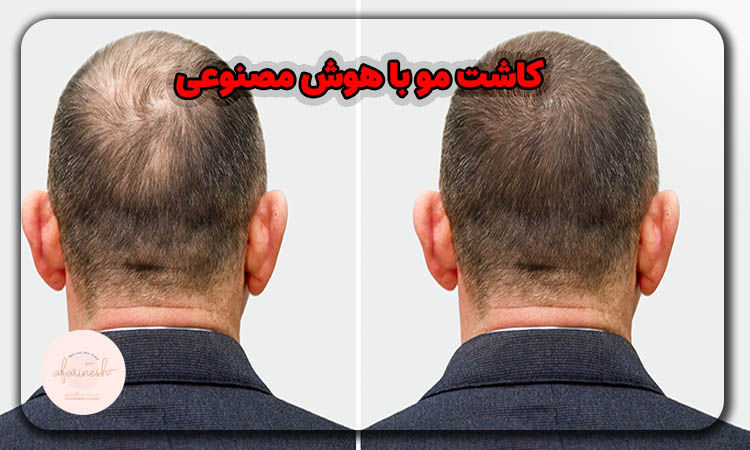 کاشت مو با هوش مصنوعی