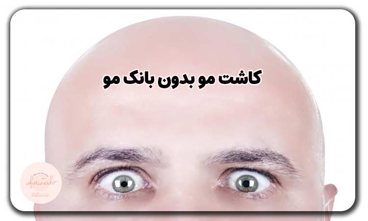 کاشت مو بدون بانک مو