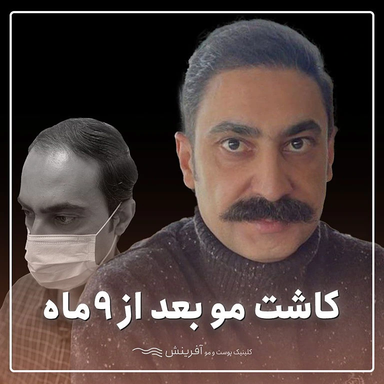 کاشت مو بعد نه ماه