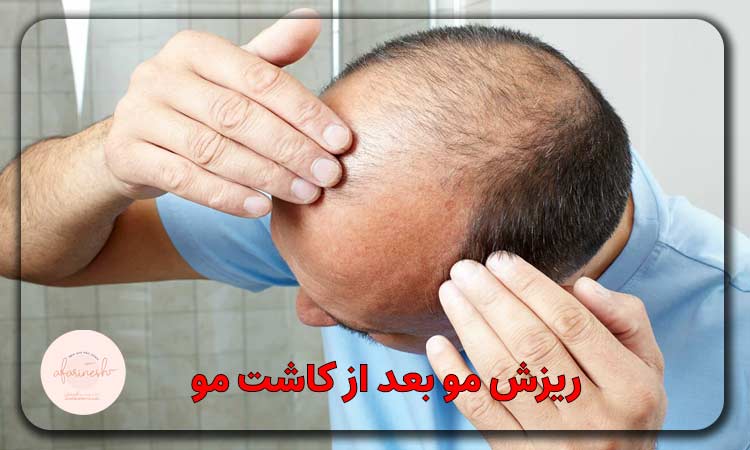 ریزش مو بعد از کاشت مو