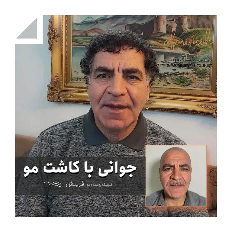 کاشت مو بعد یکسال