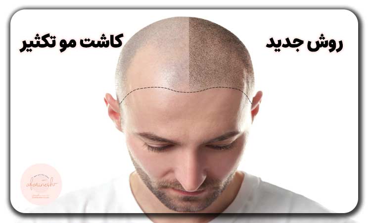 کاشت مو به روش تکثیر