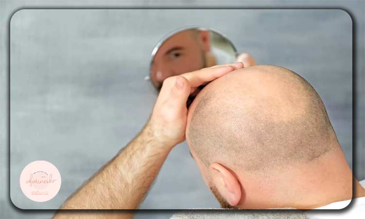 کاشت مو فوق ترکیبی