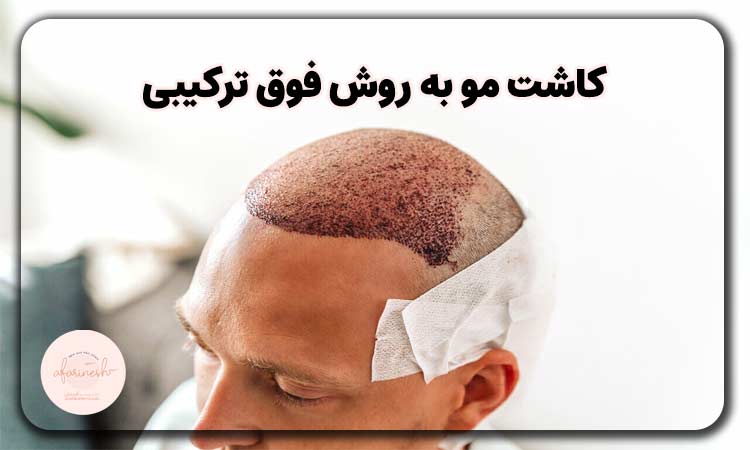 کاشت مو به روش فوق ترکیبی