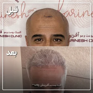 قبل و بعد کاشت مو بعد یکسال