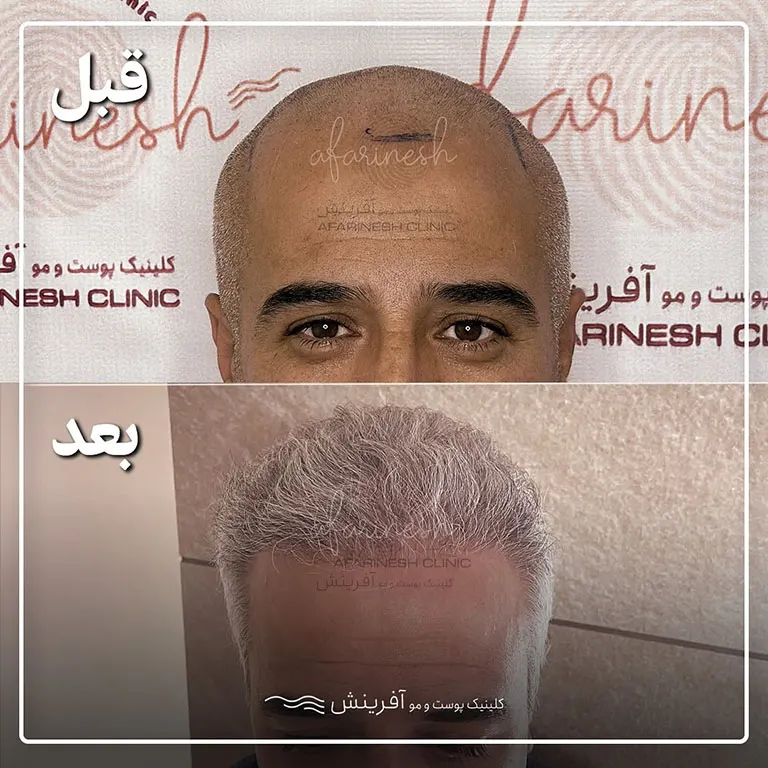 قبل و بعد کاشت مو بعد یکسال