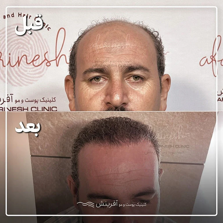 قبل و بعد از کاشت مو
