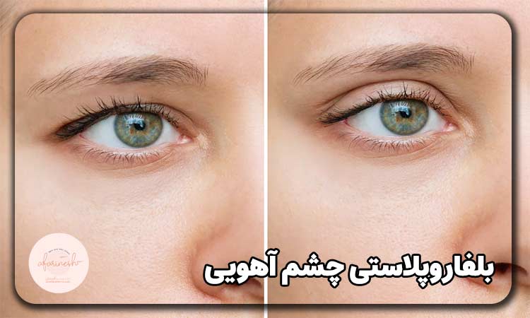 بلفاروپلاستی چشم آهویی