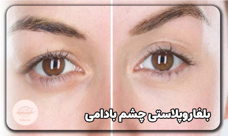 بلفاروپلاستی چشم بادامی