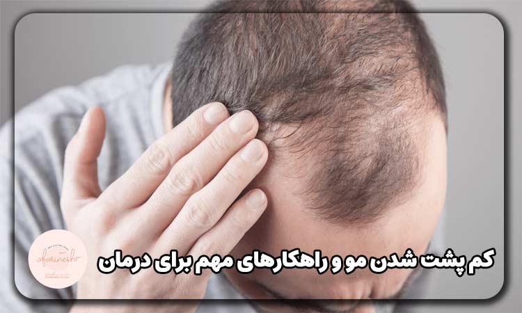علت کم پشت شدن مو
