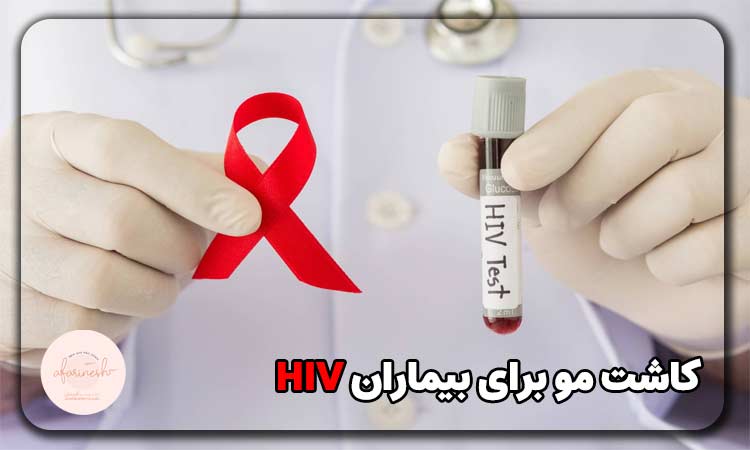 کاشت مو برای بیماران HIV