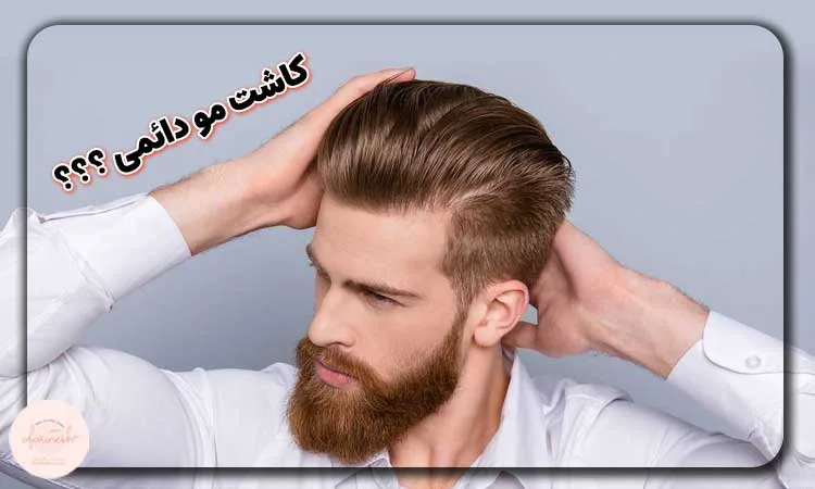 ایا کاشت مو دائمی است