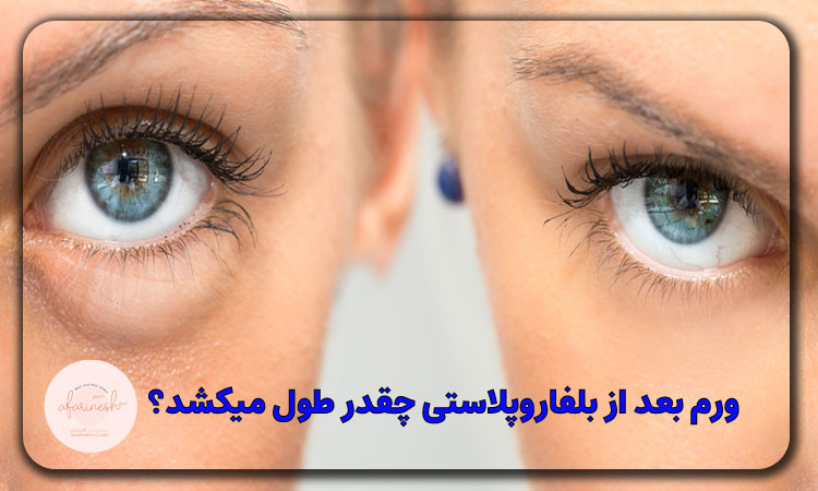 ورم بعد از بلفاروپلاستی چقدر طول میکشد؟