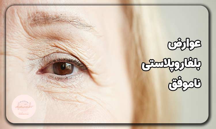 عوارض جراحی پلک ناموفق