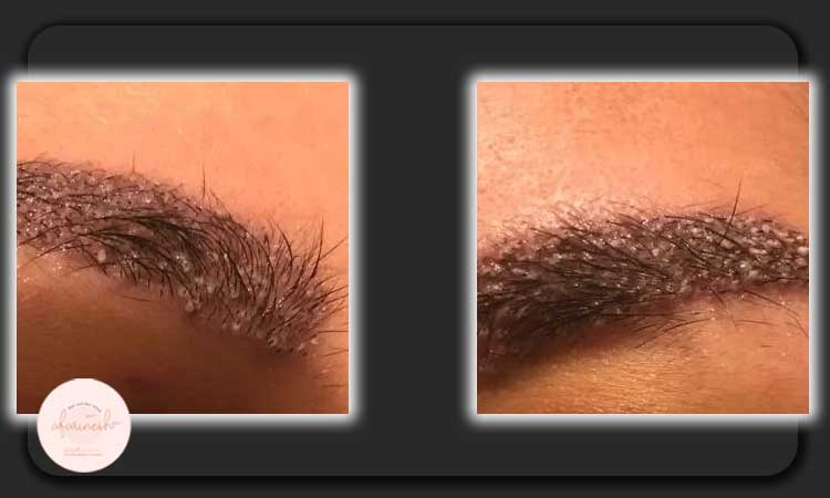 عکس دلمه های بعد از کاشت ابرو