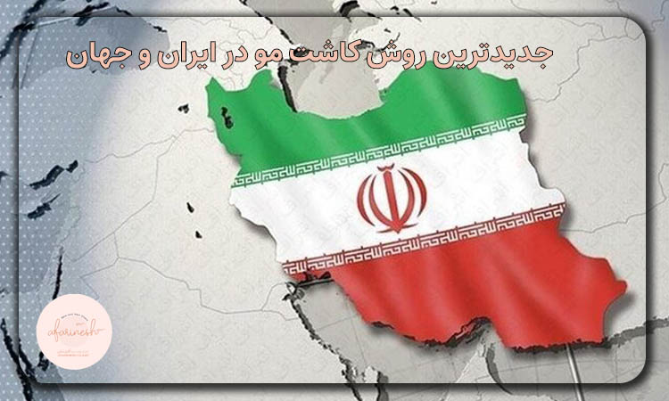 جدیدترین روش کاشت مو در ایران و جهان