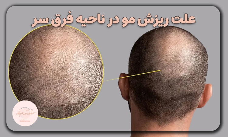 ریزش مو در ناحیه فرق سر